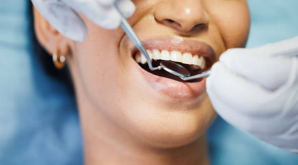 Best Emergency Wisdom Teeth Removal in Lemont, IL